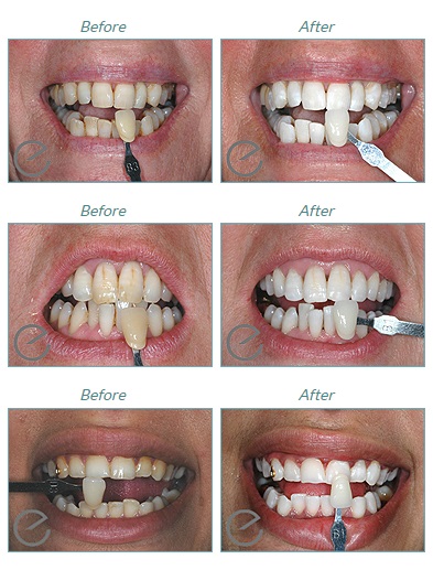 best teeth whitening in Hertfordshire 